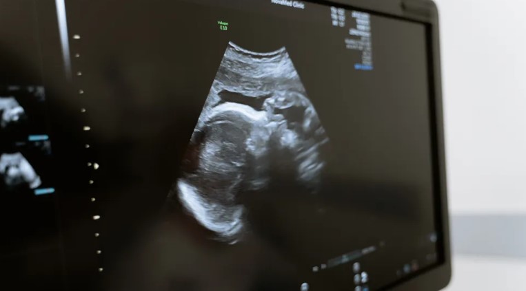 53-jarige vrouw bevalt van een tweeling, schoonzoon merkt vertrouwde moedervlekken op bij de baby's – Verhaal van de dag