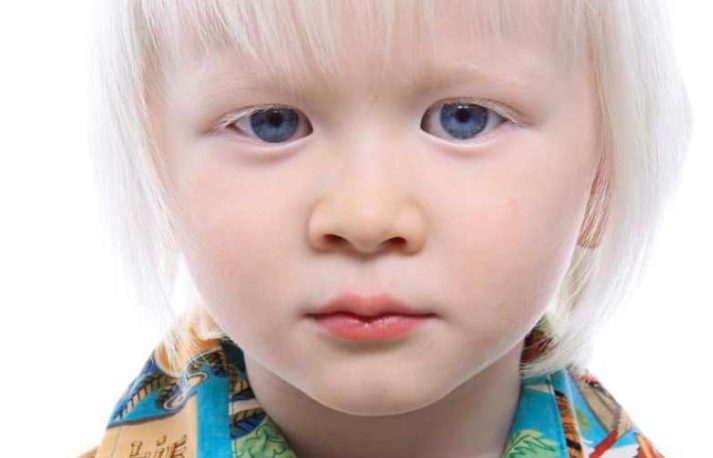 'Woe! Hij heeft echt heel blond haar.' IK WIST HET GEWOON. Mijn man glimlachte. 'Hij is een albinos.' Moeder van 2 zonen met albinisme zegt dat het beste wat ze in hen kan prenten 'zelfvertrouwen' is.